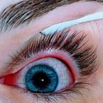 allerjik-konjuktivit